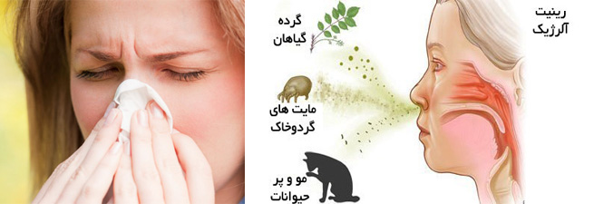 آشنایی با رینیت آلرژیک